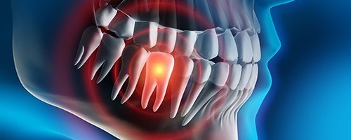 Animation of damaged tooth