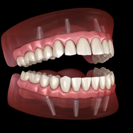 illustration of how All-on-4 implants work