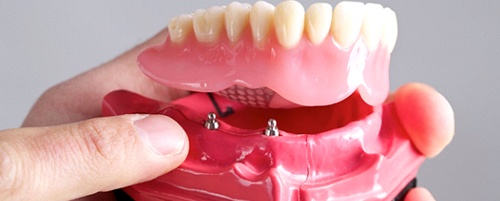 implant dentist in Mesquite holding a model of All-on-4