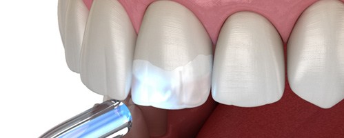 Digital image of composite resin on a tooth 