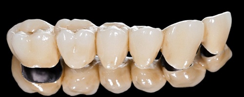 fixed bridge with porcelain crowns