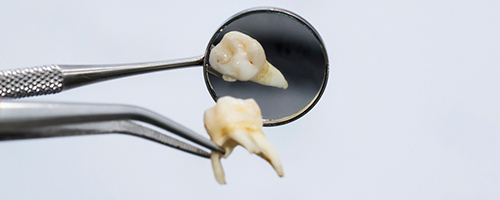 Holding a tooth by the root after tooth extraction in Mesquite, TX