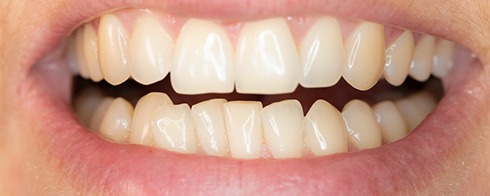 Closeup of crowded teeth in Mesquite before FastBraces®