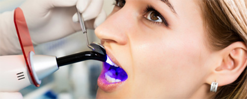 curing a dental filling