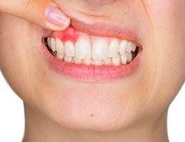Closeup of smile with damaged soft tissues