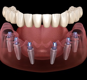 Implant denture in Mesquite