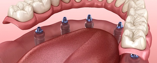 An implant denture in Mesquite