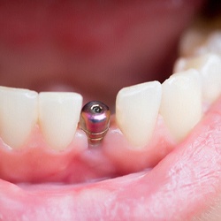 Dental implant in Mesquite