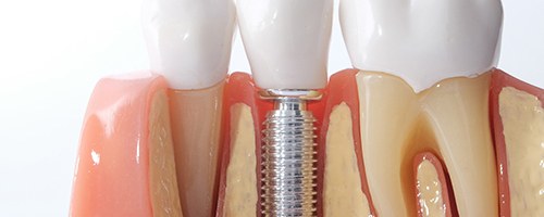 model of a dental implant in the lower jaw