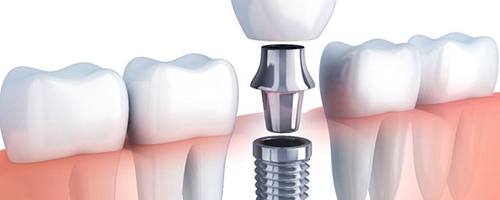 dental implant being placed in the lower jaw