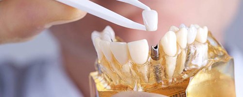 dentist placing a crown on top of a dental implant