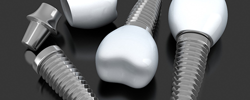 three dental implant posts with abutments and crowns