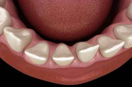 Gaps between teeth