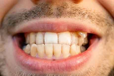 Up-close image of a person’s underbite