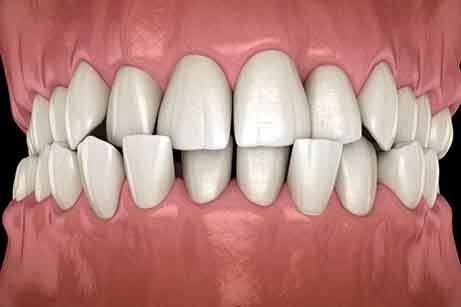 Crossbite with teeth overlapping