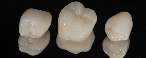 Examples of metal-free restorations