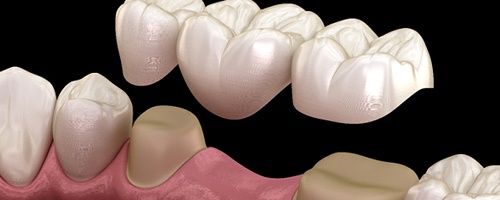 A dental bridge 