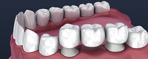 Animation of smile with dental bridge restoration