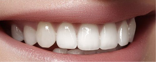 Closeup of healthy teeth with dental sealants