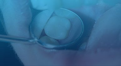 Closeup of reflection of teeth in dental mirror