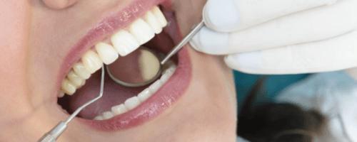 Close-up beautiful smile with dental tools