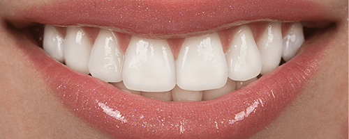 Model of porcelain veneers