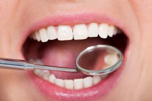 Teeth being examined with dental mirror