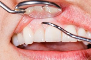 dentist pointing to a patient's gums