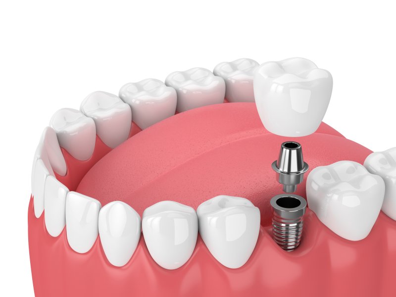 a dental implant in the lower arch