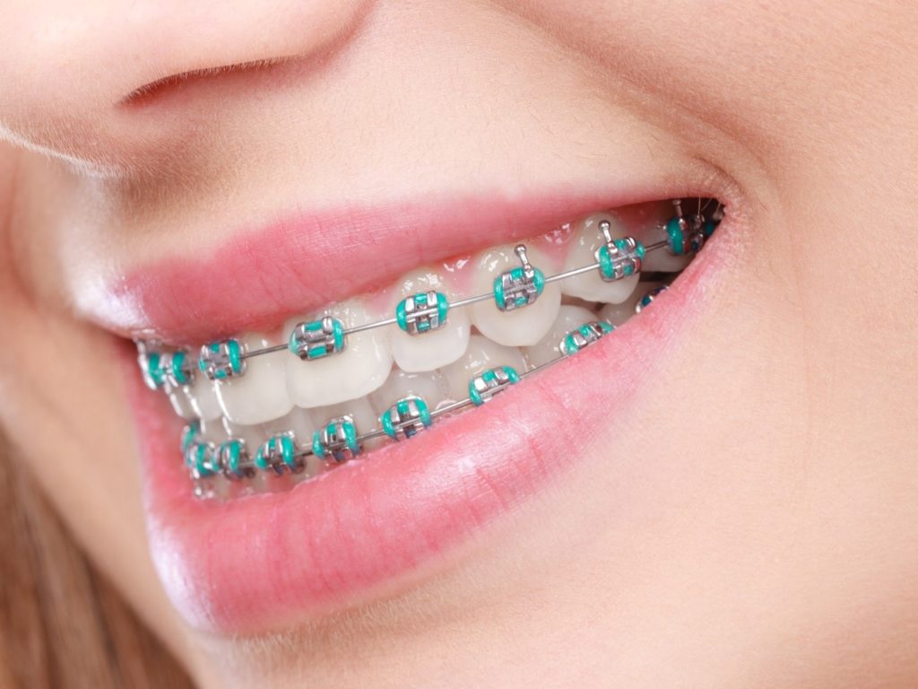 closeup of person with braces smiling after having overbite fixed