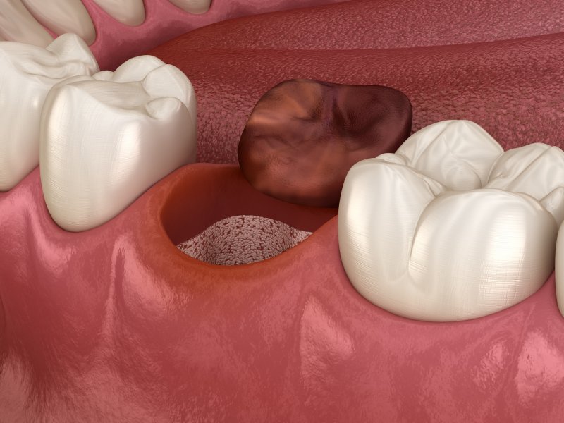 3-D diagram of dry socket