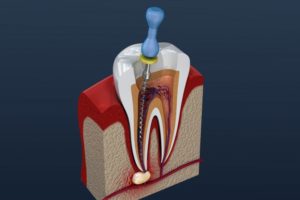 a digital image of root canal therapy