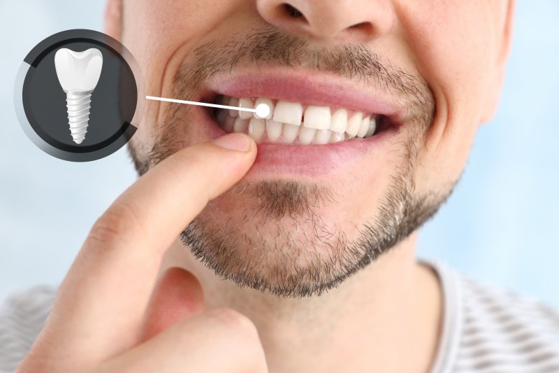 A man pointing to the dental implant in his smile