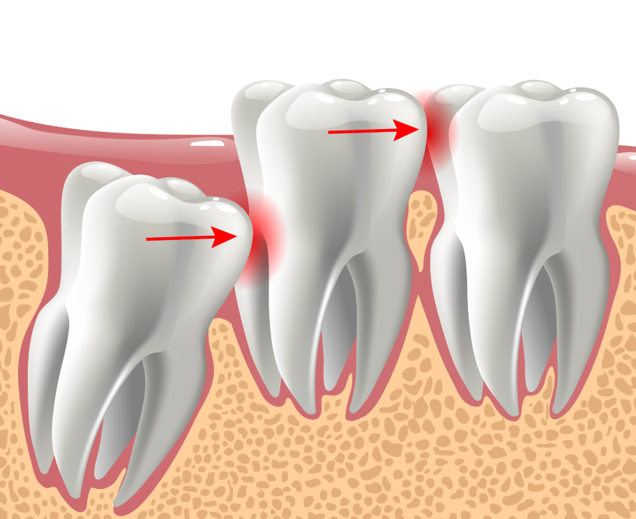 Illustration of wisdom tooth